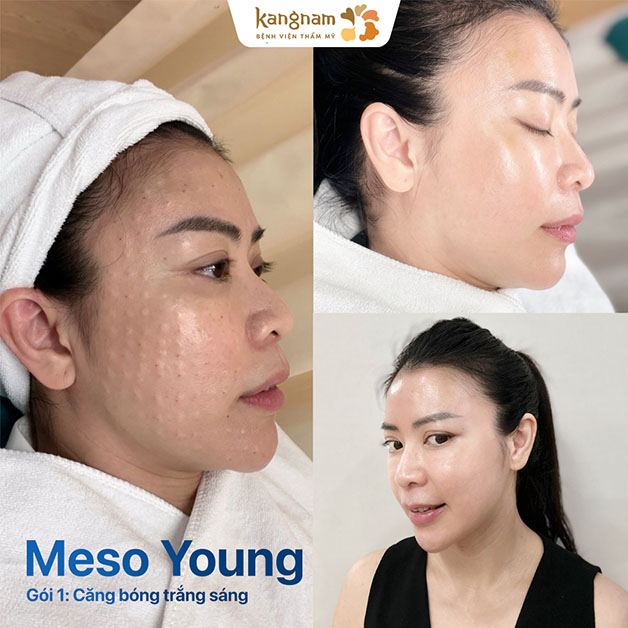 Khách hàng tiêm meso tại Kangnam, sở hữu làn da căng bóng và trắng sáng tức thì