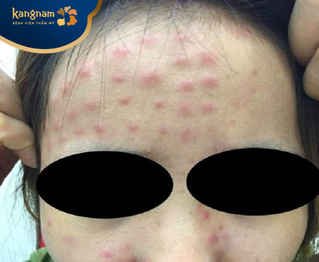 Da có thể bị sưng tấy kéo dài bởi tiêm meso quá nhiều lần trong một thời gian ngắn