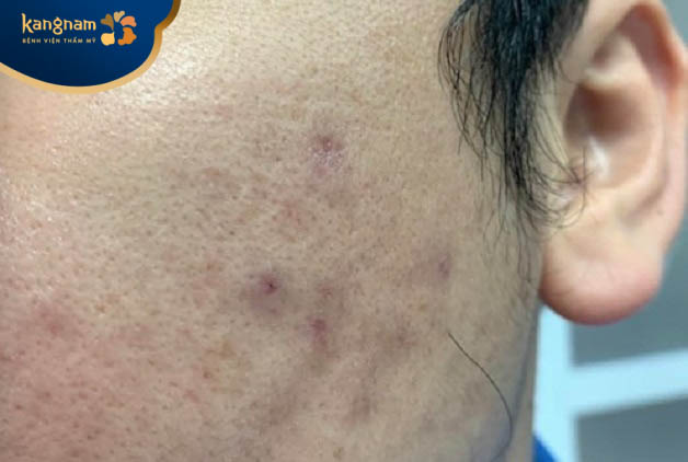 Da có thể bị nhiễm trùng sau tiêm meso quá nhiều lần