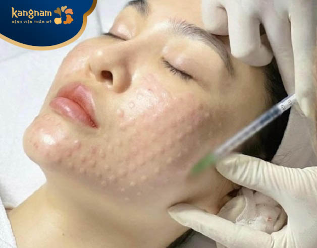 Tiêm meso nhiều lần trong một thời gian ngắn có tốt không