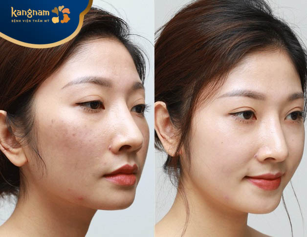 Những người nên tiêm meso trắng da