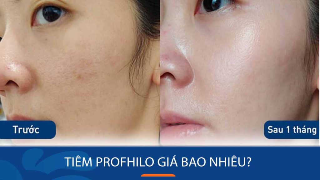 Tiêm Profhilo Giá Bao Nhiêu? Cập Nhật Bảng Giá Mới Nhất