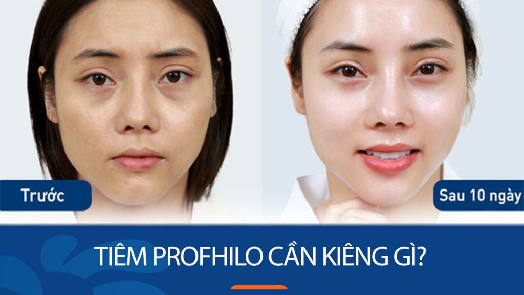 Tiêm Profhilo cần kiêng gì? 5 điều tuyệt đối nên tránh sau tiêm để đạt hiệu quả tối ưu