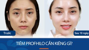 Tiêm Profhilo cần kiêng gì? 5 điều tuyệt đối nên tránh sau tiêm để đạt hiệu quả tối ưu