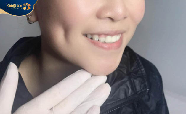 Sở hữu má lúm đồng tiền bằng phương pháp phẫu thuật