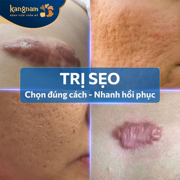 Trị sẹo lồi hiệu quả, nhanh hồi phục, thu nhỏ kích thước sẹo tối đa