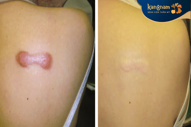 Xóa bỏ sẹo lồi lâu năm ở lưng, làn da trở nên đều màu, mịn màng