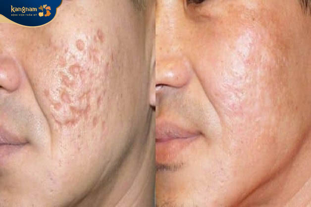 Thẩm mỹ xóa sẹo giúp thu nhỏ vùng da sẹo lõm