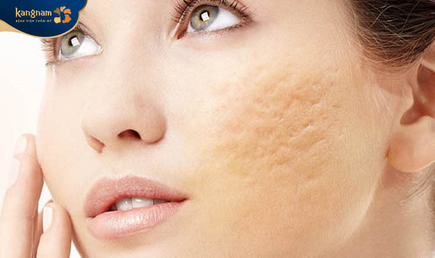 Phẫu thuật thẩm mỹ xóa sẹo giúp loại bỏ sẹo lõm lâu năm
