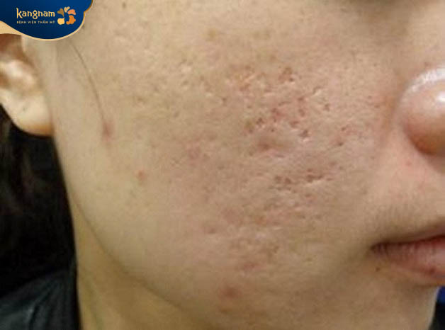 Sẹo rỗ mụn không khó điều trị nếu áp dụng đúng cách