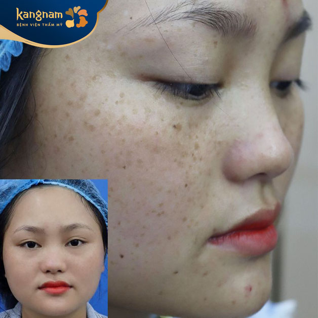 Tàn nhang lâu năm 2 bên má được loại bỏ hoàn toàn