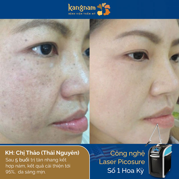 Chị Thảo ( Thái Nguyên) cũng tìm đến Kangnam vì công nghệ trị nám hiện đại, hiệu quả