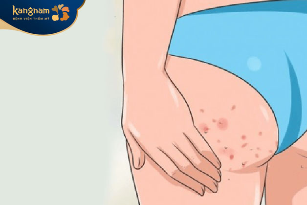 Do triệt lông sai cách