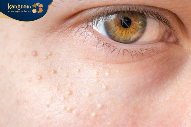 mụn thịt xuất hiện nhiều ở gò má là do sự rối loạn chuyển hóa dưới da