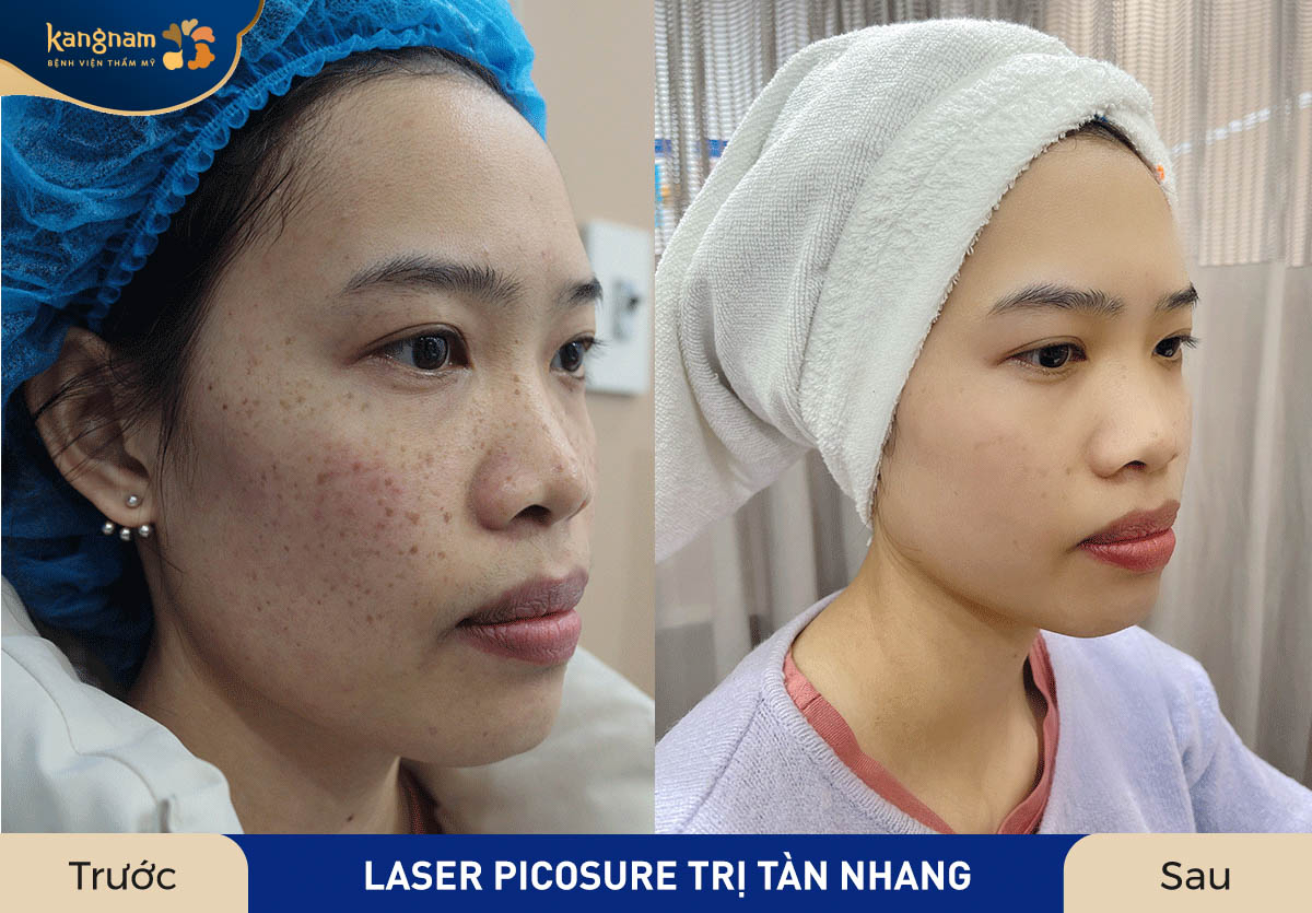 Loại bỏ sạch tàn nhang, gương mặt trở nên tươi sáng, mịn màng, trẻ ra vài tuổi