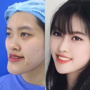 Chỉnh hàm móm – Tạo khớp cắn chuẩn, giải quyết vĩnh viễn