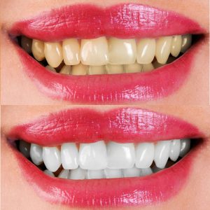 Bọc răng sứ – Phục hình răng thẩm mỹ chắc chắn, bền đẹp