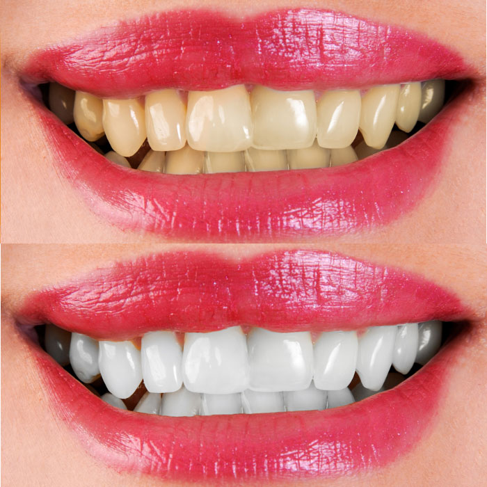 Bọc răng sứ – Phục hình răng thẩm mỹ chắc chắn, bền đẹp