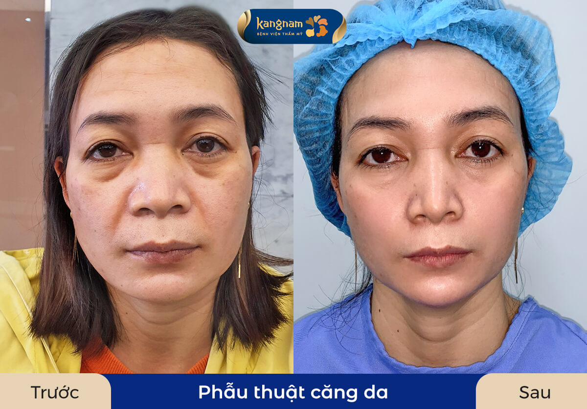 Gương mặt trẻ trung, căng bóng và mịn màng hơn sau căng da
