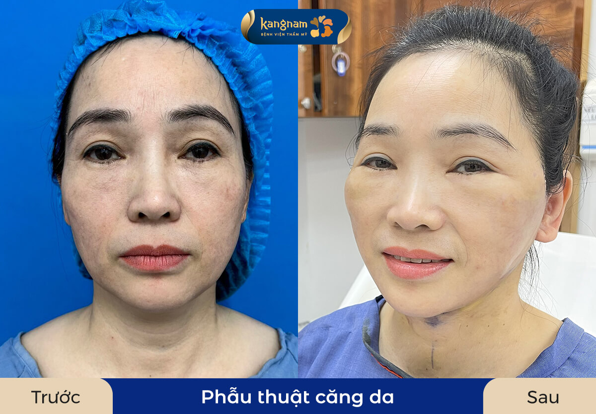 Da nhăn nheo, chùng nhão, vết chân chim được cải thiện rõ rệt