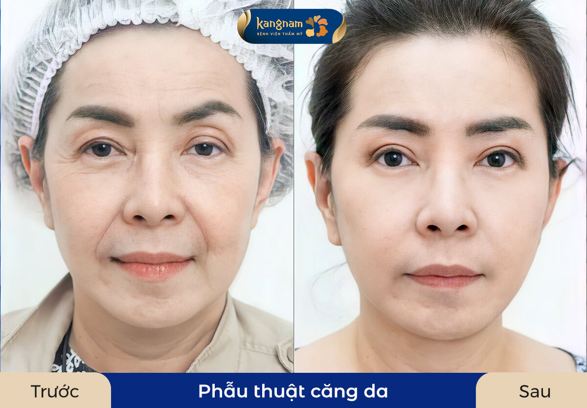 Phẫu thuật căng da giúp khách hàng lấy lại nét xuân