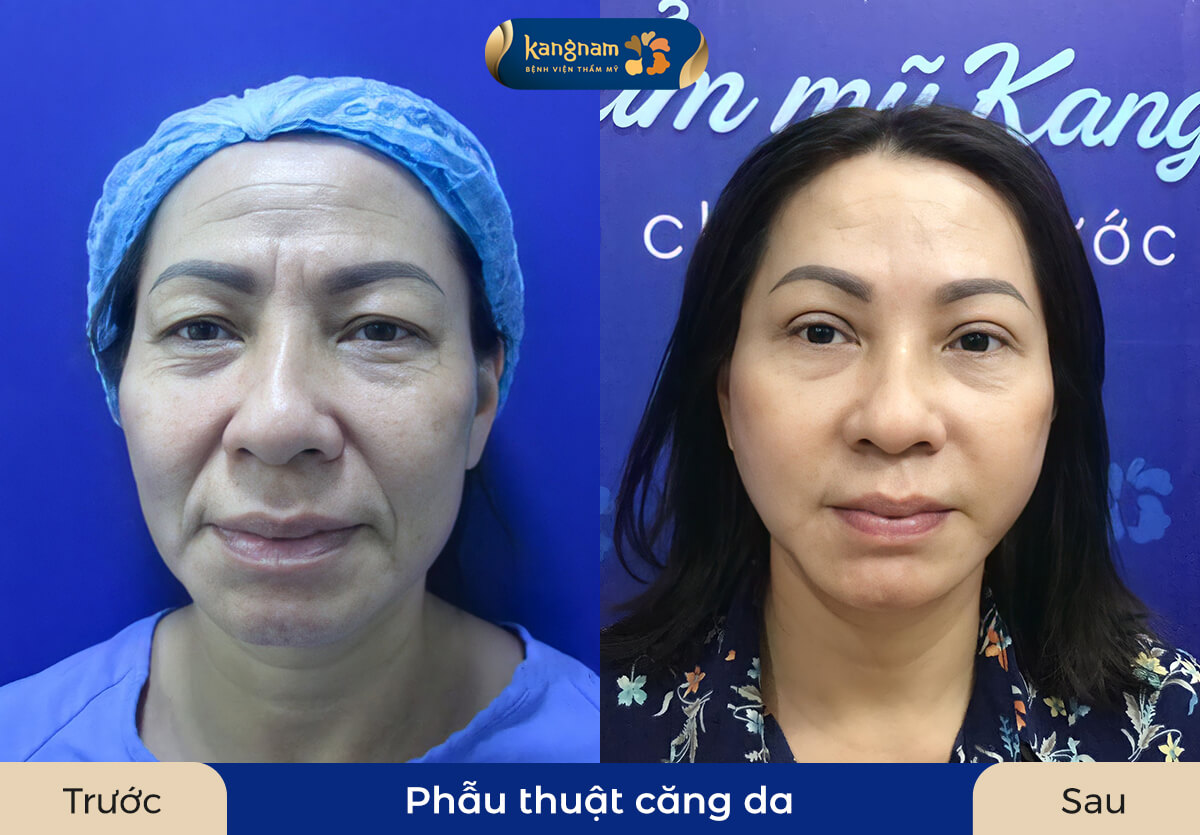 Căng da công nghệ hiện đại, an toàn và mang lại hiệu quả cao