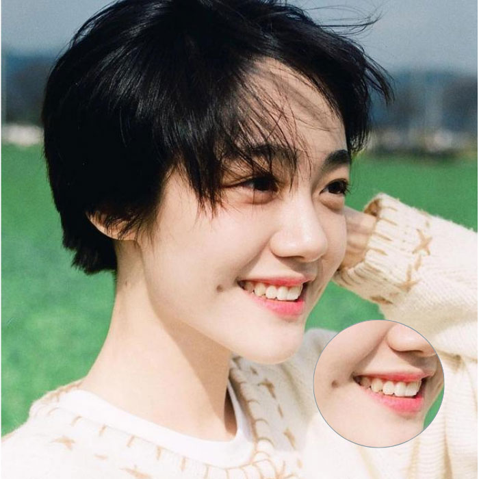 Tạo má lúm Cutie – Má lúm duyên xinh, không cần phẫu thuật