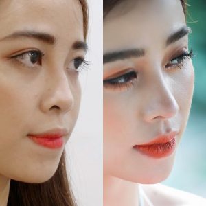 Sửa mũi gồ là gì? Các phương pháp khắc phục mũi gồ phổ biến hiện nay