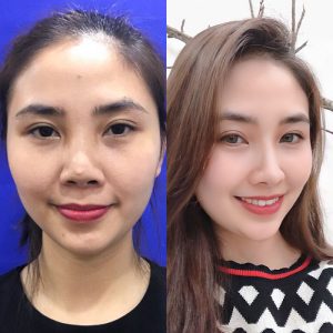 Khắc phục mũi hỏng: Dấu hiệu nhận biết & giải pháp an toàn