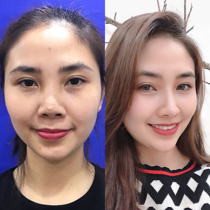 Khắc phục mũi hỏng: Dấu hiệu nhận biết & giải pháp an toàn