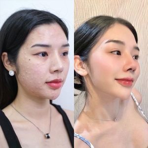 Tiêm trẻ hóa da là gì? Lợi ích và kỹ thuật tiêm phổ biến!