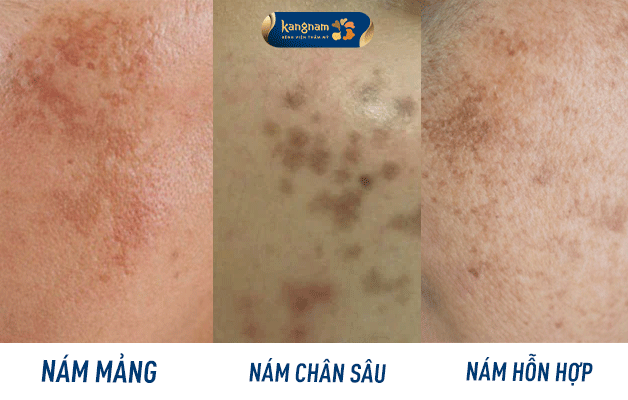 Các loại nám thường gặp