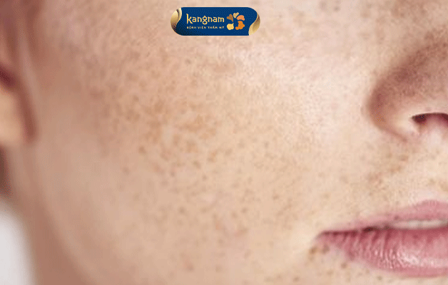 Vùng da xuất hiện những đốm tàn nhang nhỏ, mọc đơn lẻ hoặc theo từng mảng