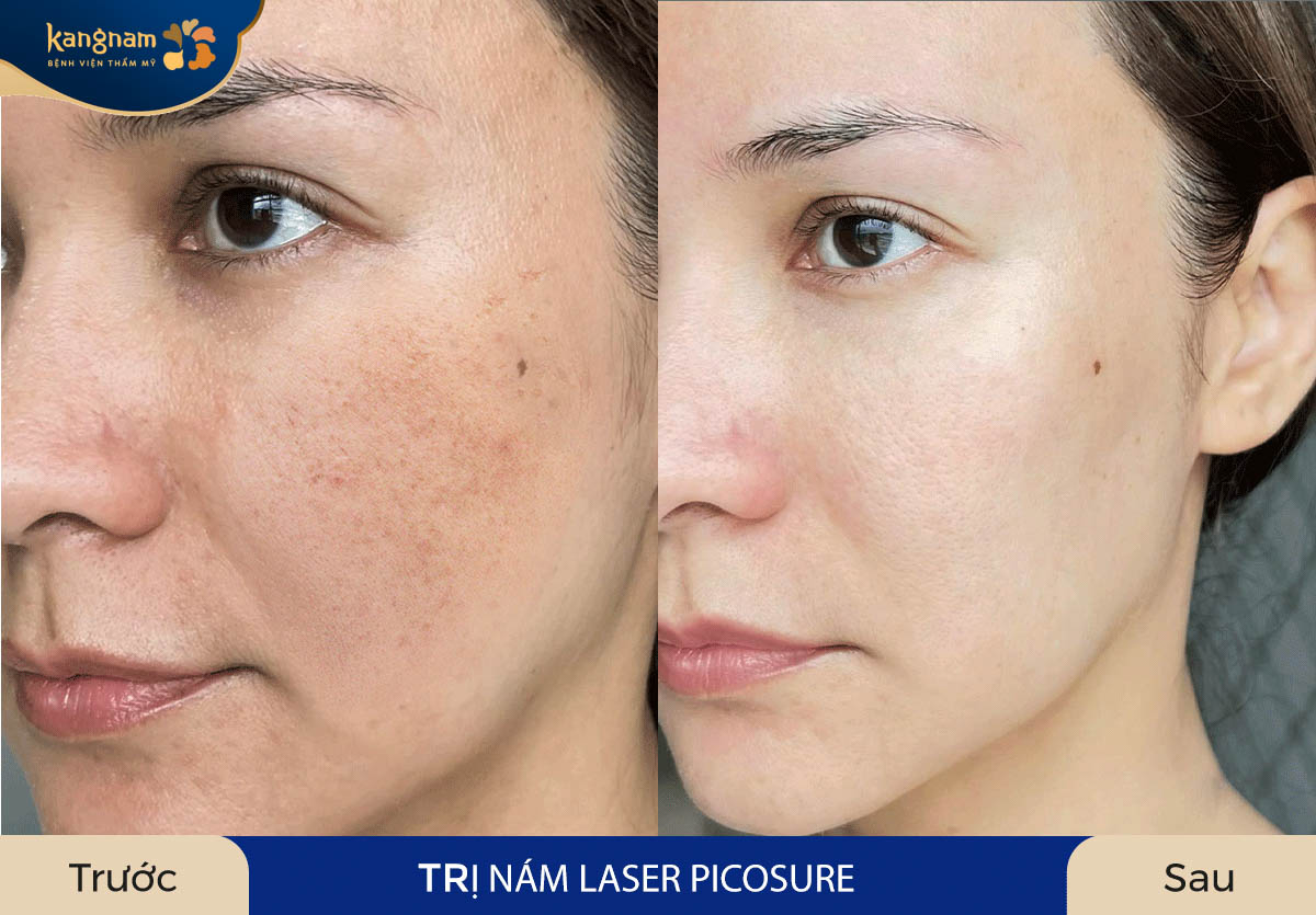 Công nghệ trị nám Laser Picosure