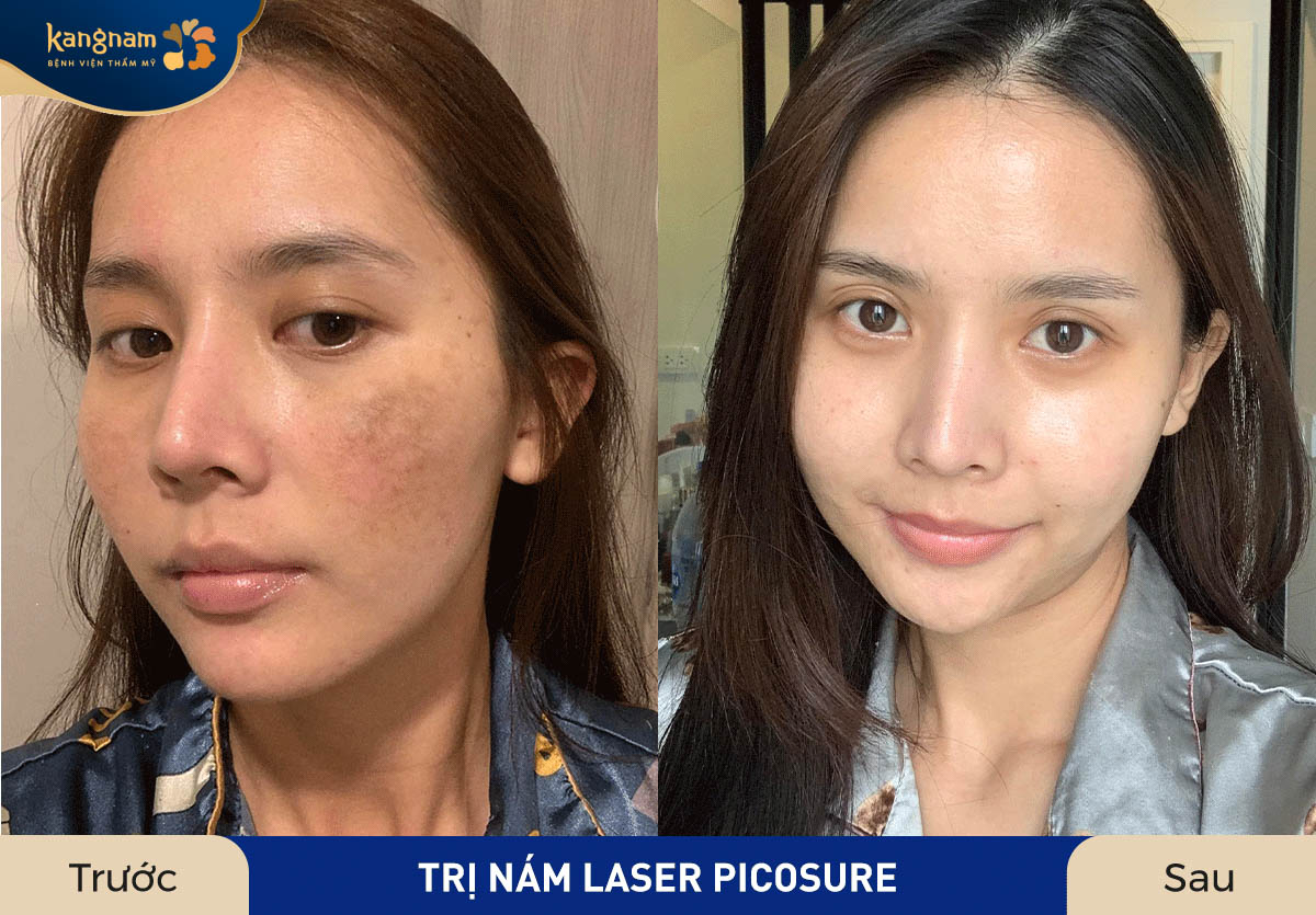 Gương mặt cải thiện rõ ràng, tạm biệt thâm nám sau điều trị tại Kangnam