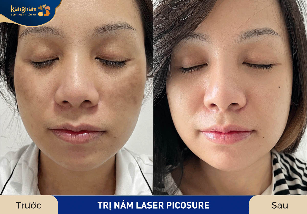 Chị khách sở hữu làn da mịn màng, đều màu khi áp dụng công nghệ điều trị cao