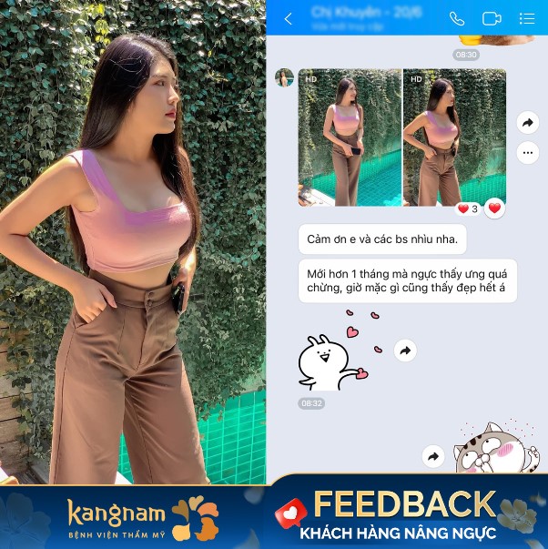 Feedback của chị khách hàng sau hơn 1 tháng nâng ngực