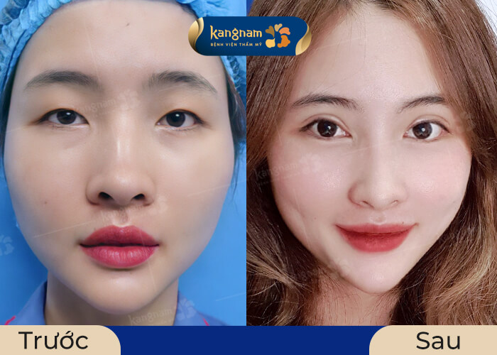 Đôi mắt long lanh, to tròn và cân đối sau khi mở góc mắt