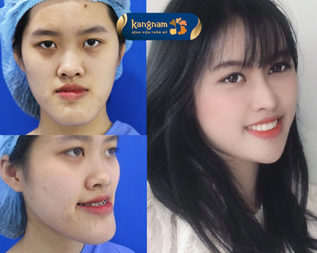 Chỉnh sửa hàm móm tại Kangnam áp dụng kỹ thuật tiên tiến BSSO