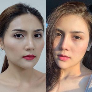 Hạ gò má – Hết sát phu, chuẩn nét đẹp dịu dàng