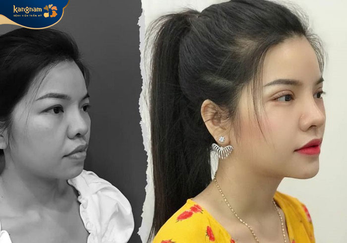 Căng da giúp trẻ hóa gương mặt toàn diện