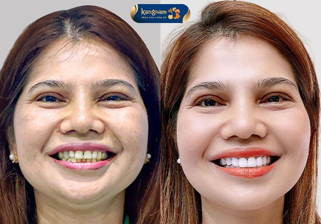 Thiết kế răng sứ chuẩn xác, tỉ lệ hoàn hảo