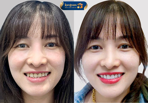 Kết hợp lớp phủ Nano, cho màu sắc tự nhiên như thật