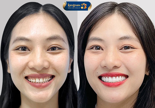 Kết quả bọc răng sứ chuẩn đẹp