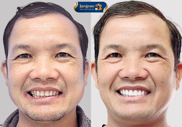 Thời gian phục hình nhanh chóng