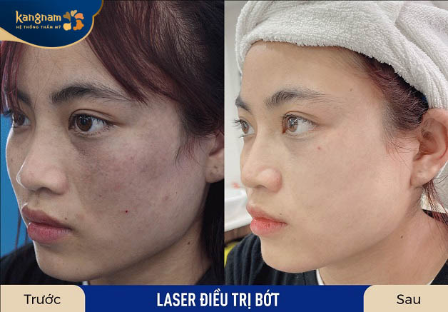 Da cải thiện rõ rệt sau laser trị bớt
