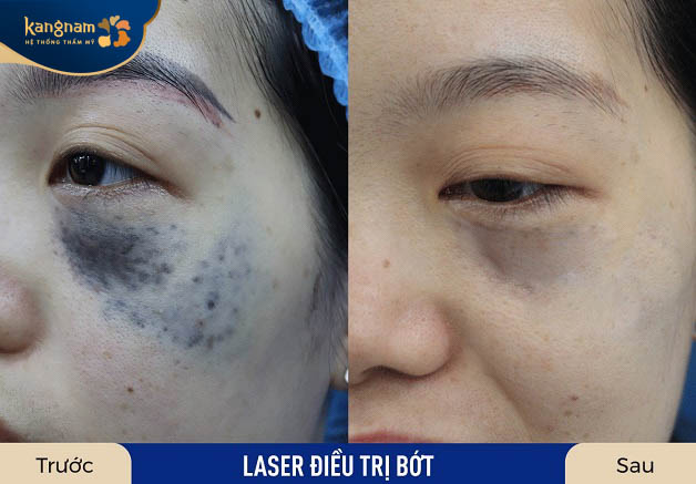 Bớt đen, sẫm màu được khắc phục lên đến 95%