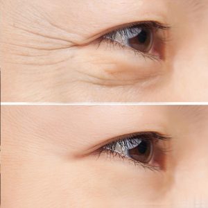 Tiêm Botox là gì? Kỹ thuật này có an toàn không?