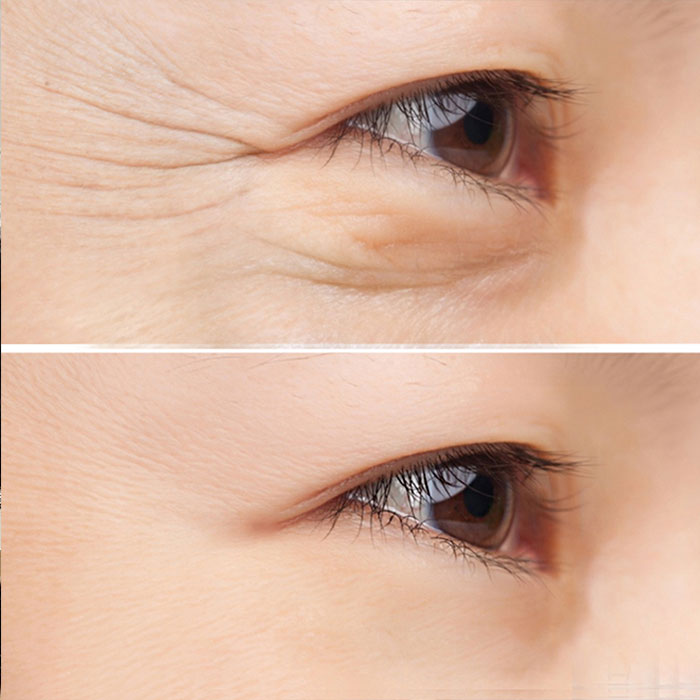 Tiêm Botox là gì? Kỹ thuật này có an toàn không?