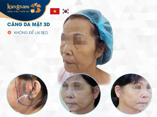 Loại bỏ mỡ thừa, lấy lại làn da mịn màng